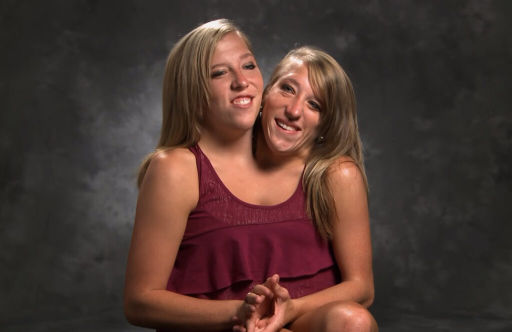 abby und brittany hensel tot